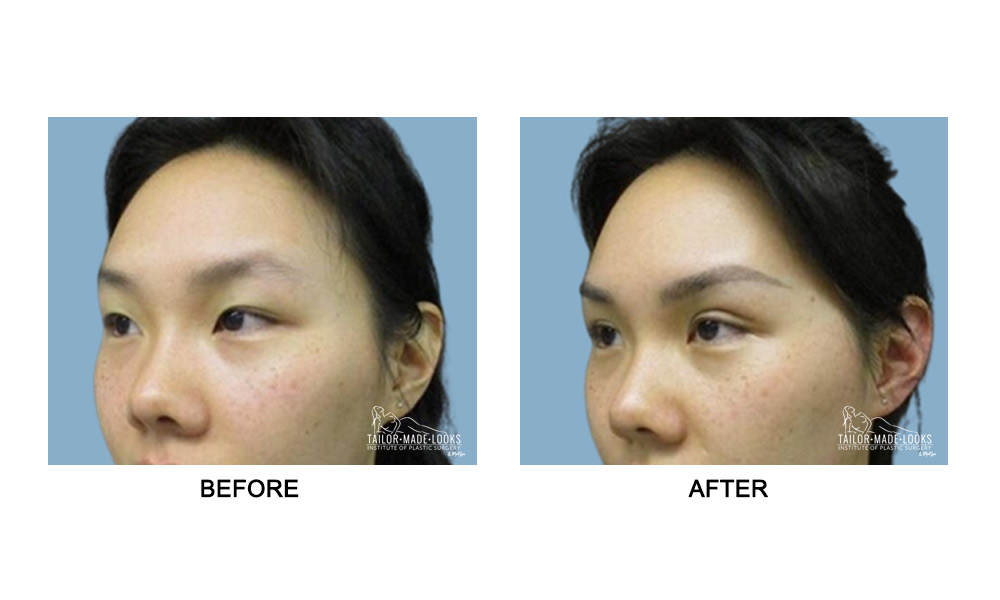 Asian Blepharoplasty Image