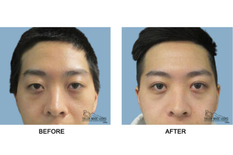 Asian Blepharoplasty Image