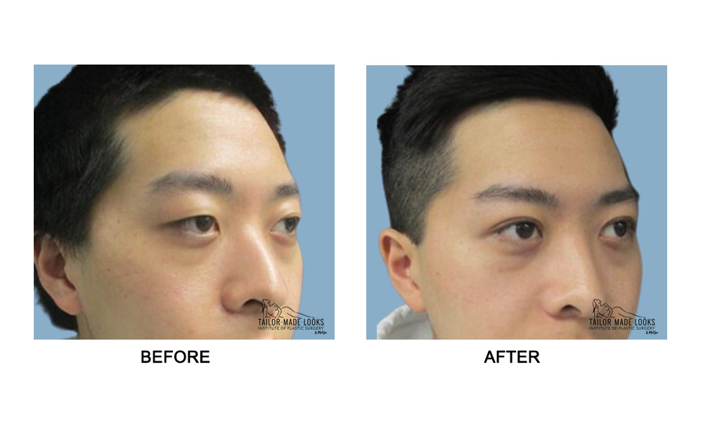 Asian Blepharoplasty Image