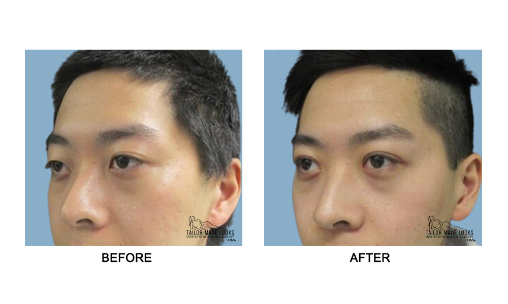 Asian Blepharoplasty Image