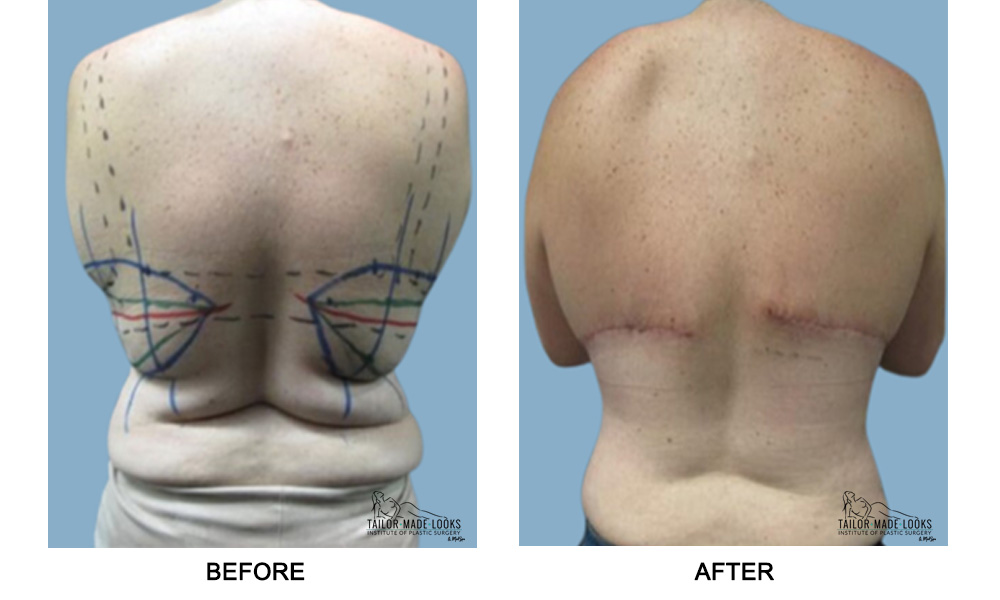 backlift surgery image