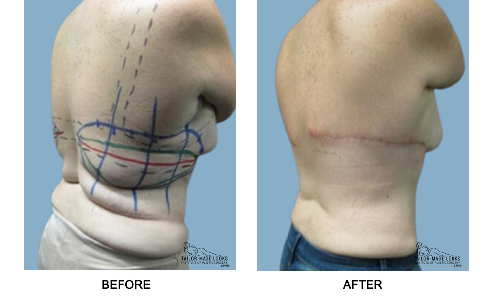 backlift surgery image