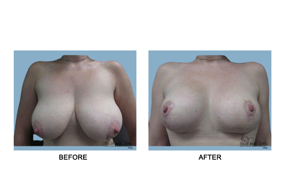 Breast Lift