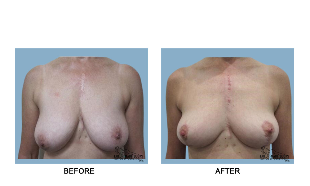 Breast Lift