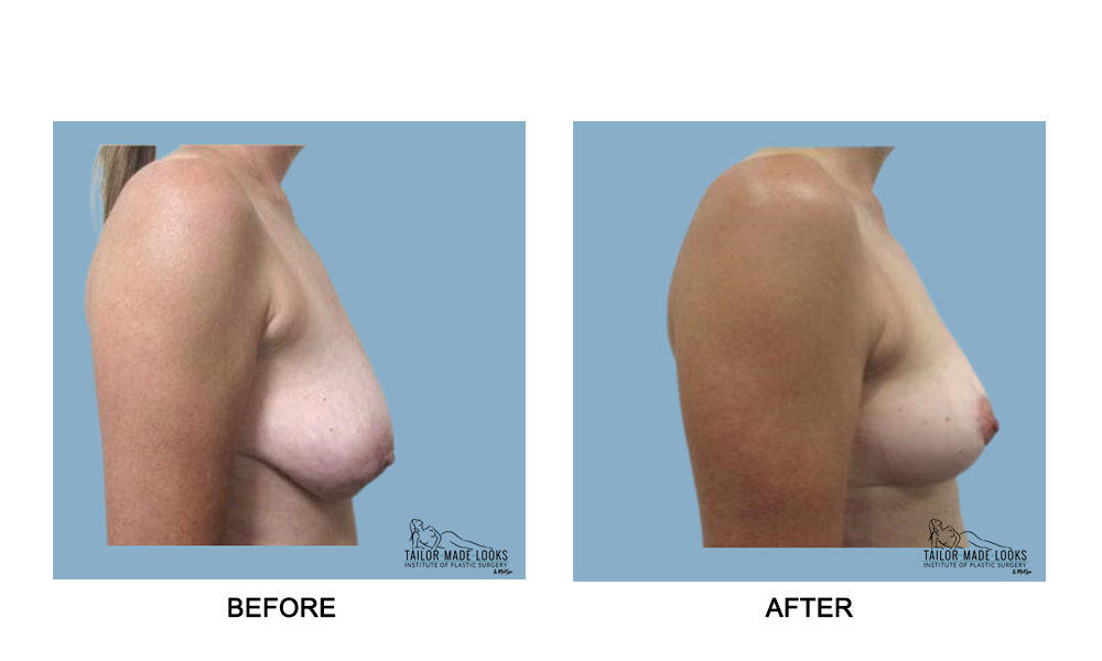 Breast Lift