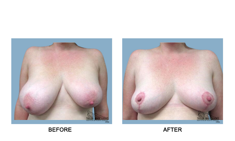 Breast Lift