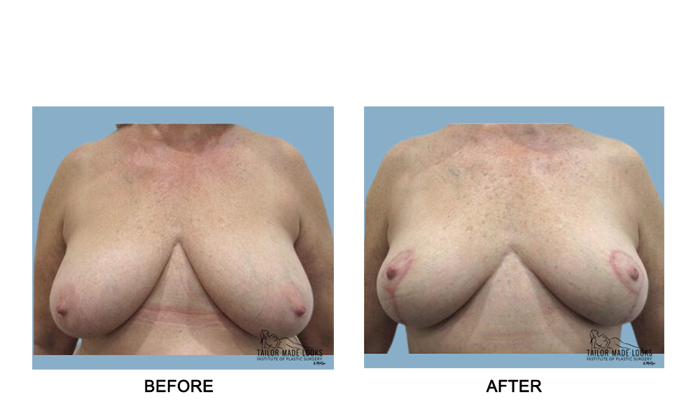 Breast Lift