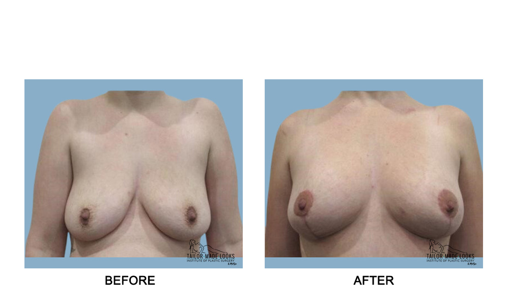 Breast Lift