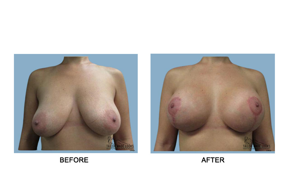 Breast lift + Implant