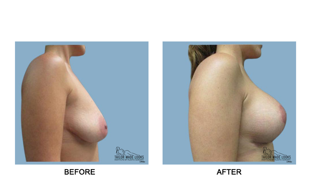 Breast lift + Implant