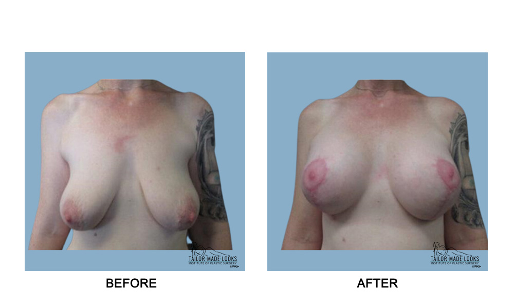 Breast lift + Implant