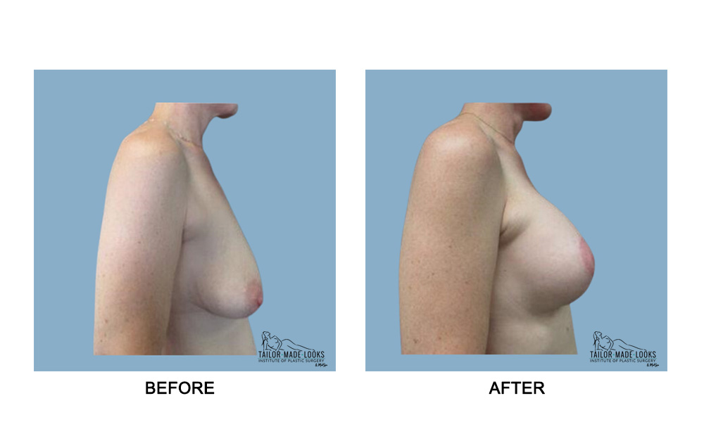 Breast lift + Implant