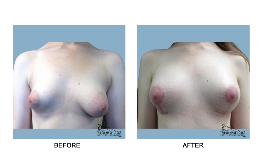 Breast lift + Implant