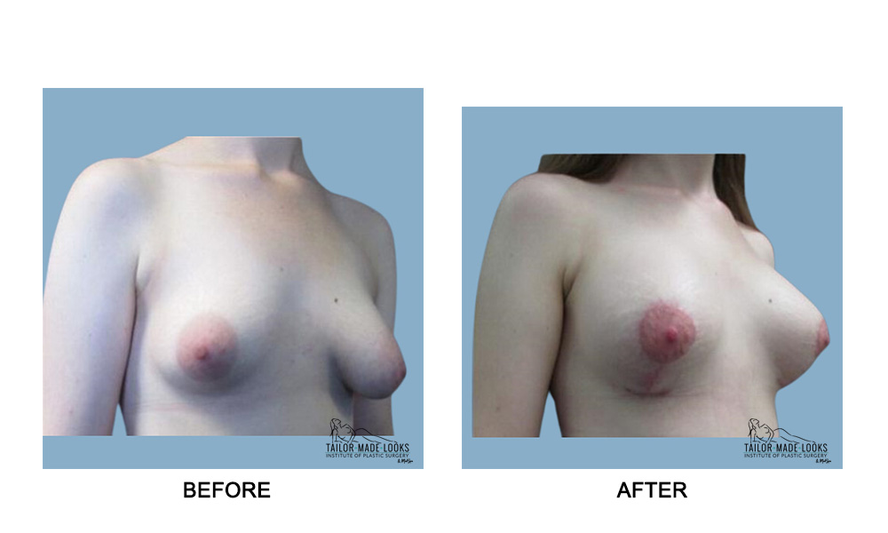 Breast lift + Implant