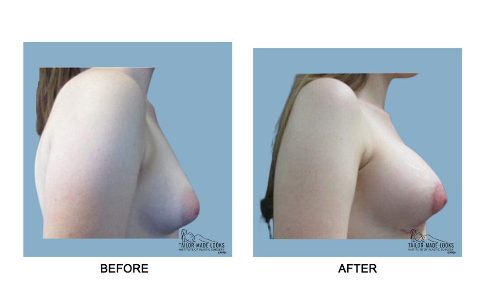 Breast lift + Implant