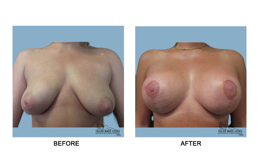 Breast lift + Implant