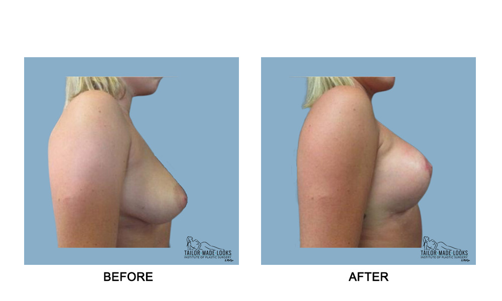 Breast lift + Implant