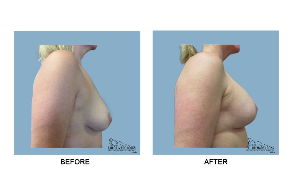 Breast lift + Implant