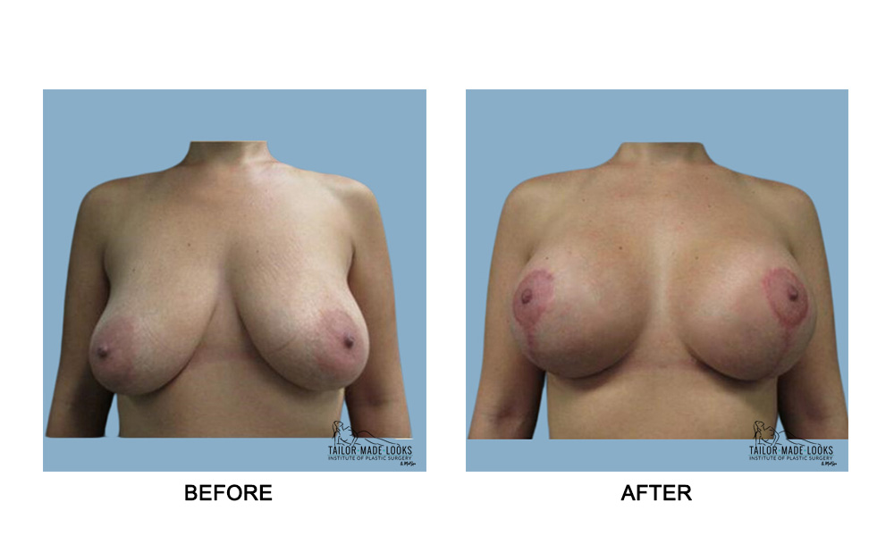 Breast lift + Implant