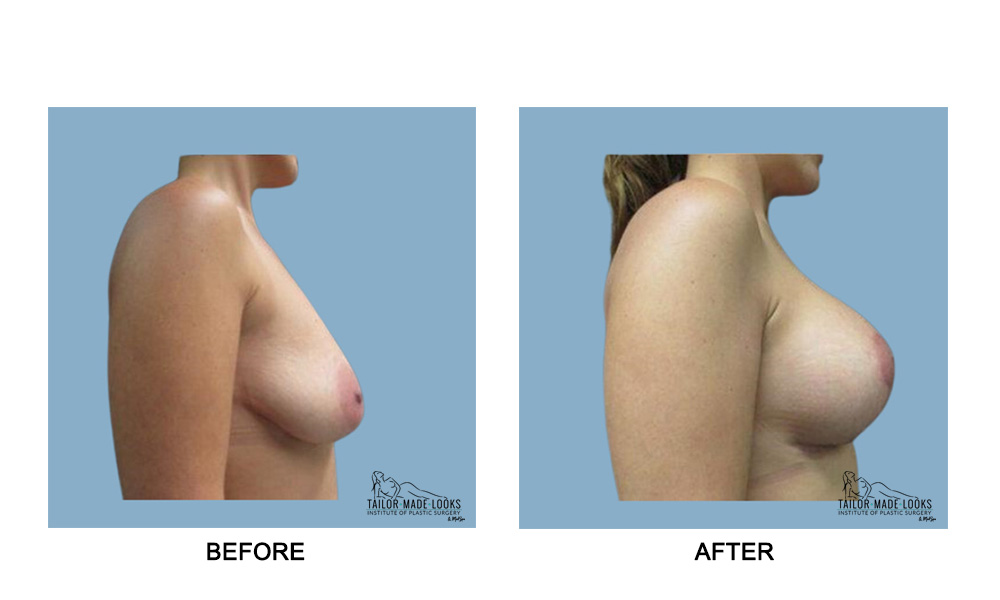 Breast lift + Implant