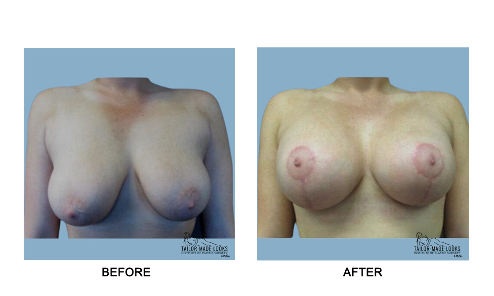 Breast lift + Implant