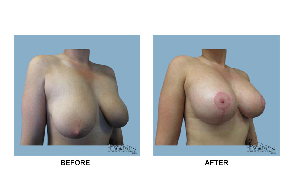 Breast lift + Implant