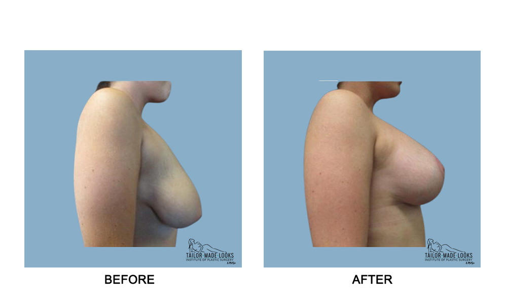 Breast lift + Implant