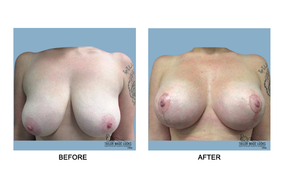 Breast lift + Implant