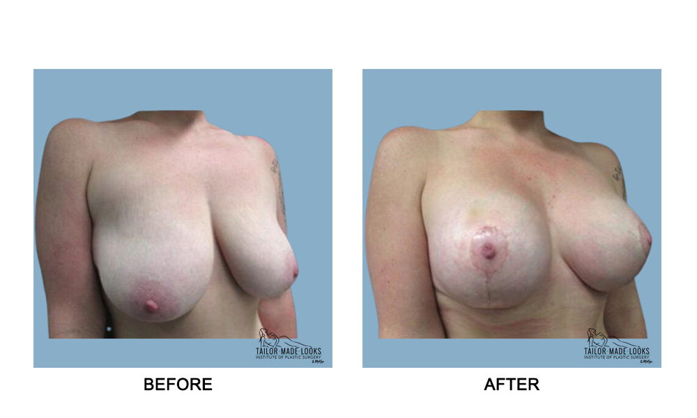 Breast lift + Implant