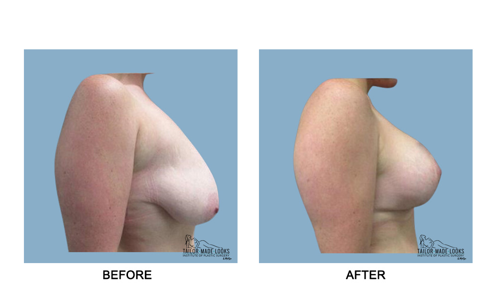 Breast lift + Implant