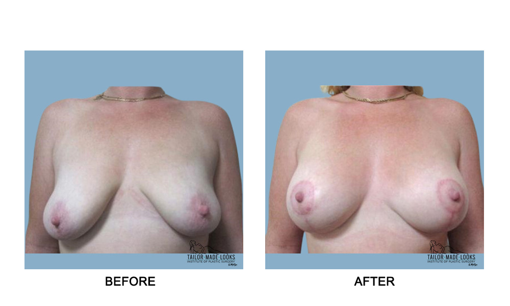 Breast lift + Implant
