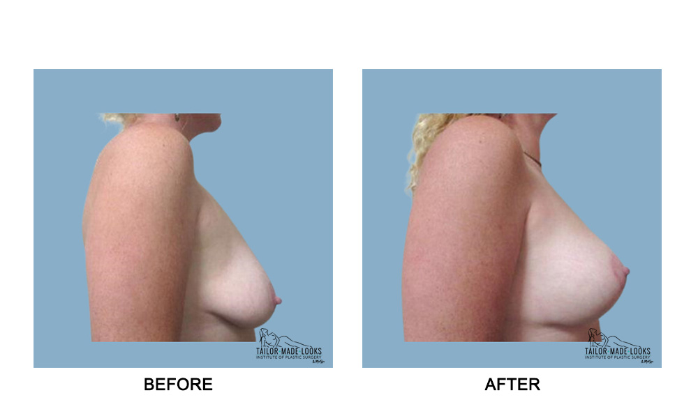 Breast lift + Implant