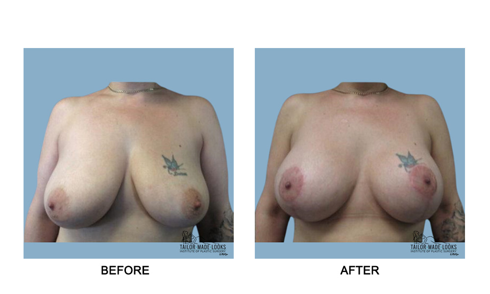 Breast lift + Implant