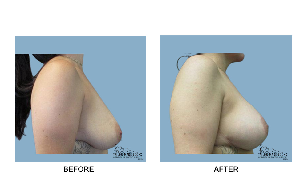 Breast lift + Implant