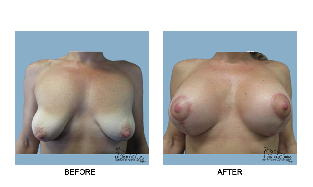 Breast lift + Implant