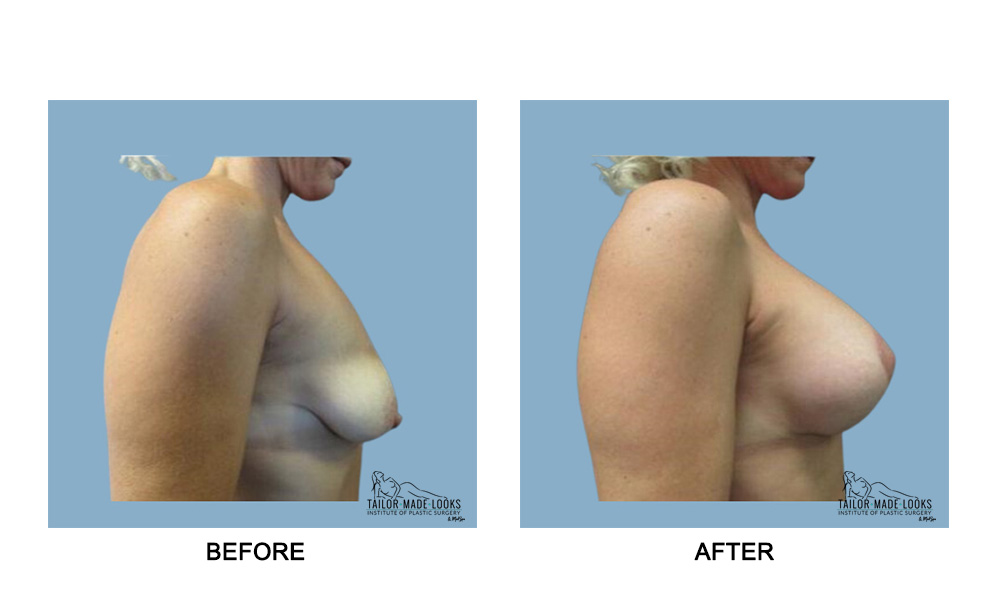 Breast lift + Implant