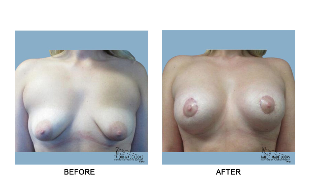 Breast lift + Implant