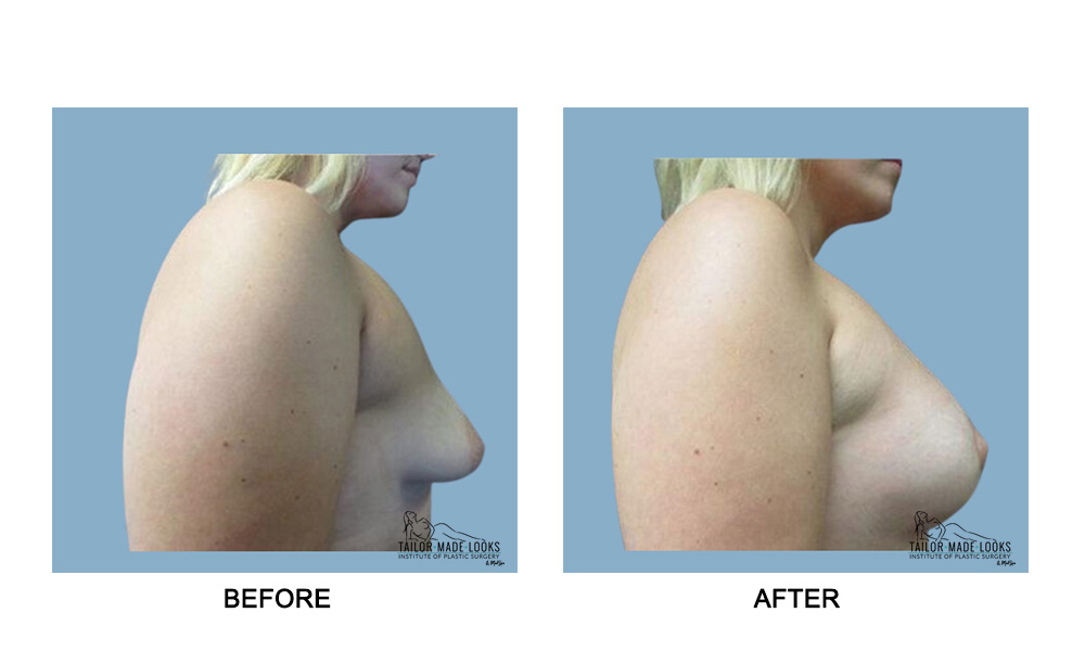 Breast lift + Implant