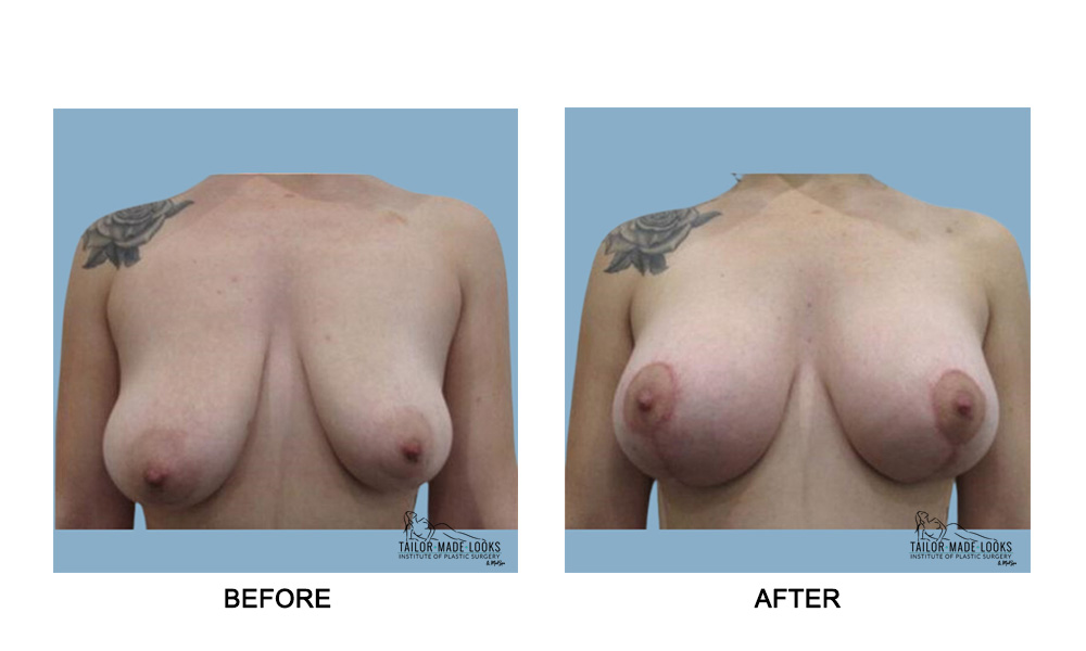 Breast lift + Implant