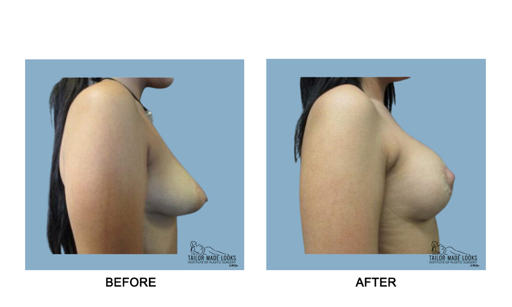 Breast lift + Implant