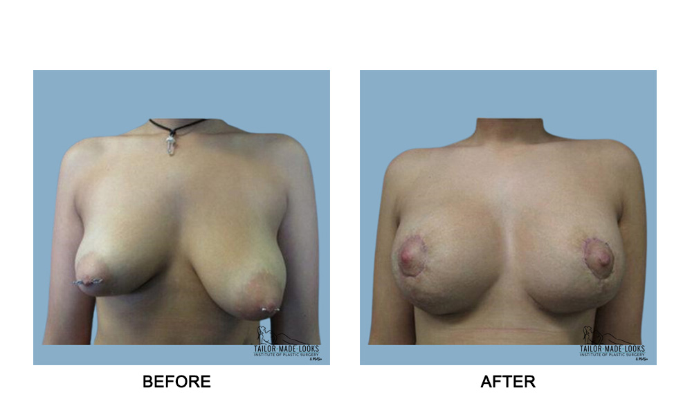 Breast lift + Implant