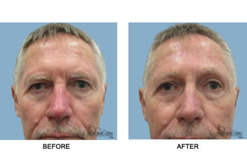 Face brow lift image