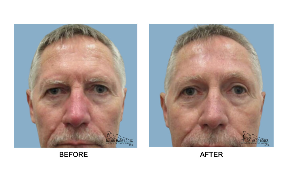 Face brow lift image