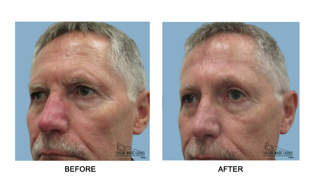 Face brow lift image