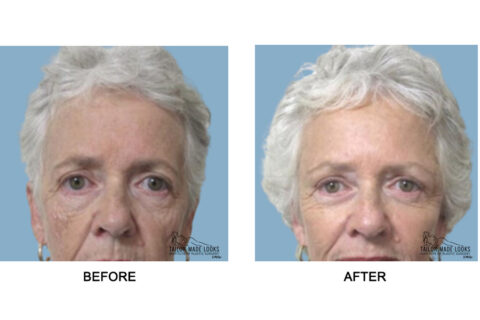 Face brow lift image