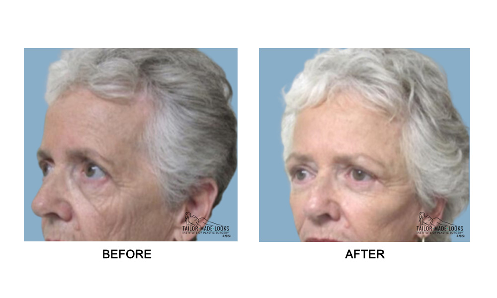 Face brow lift image