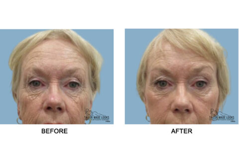 Face brow lift image