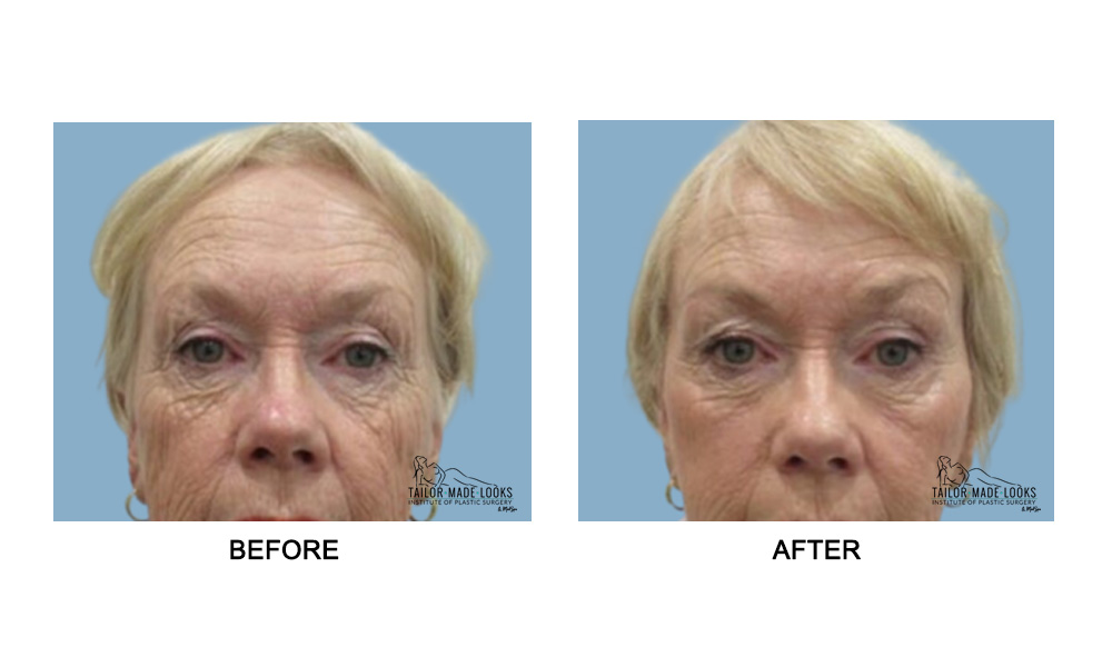 Face brow lift image