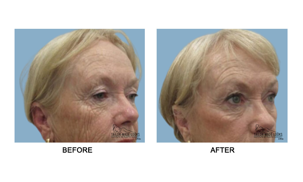 Face brow lift image