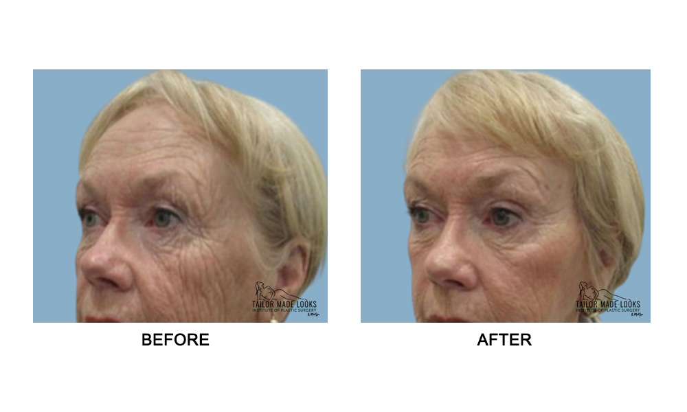 Face brow lift image